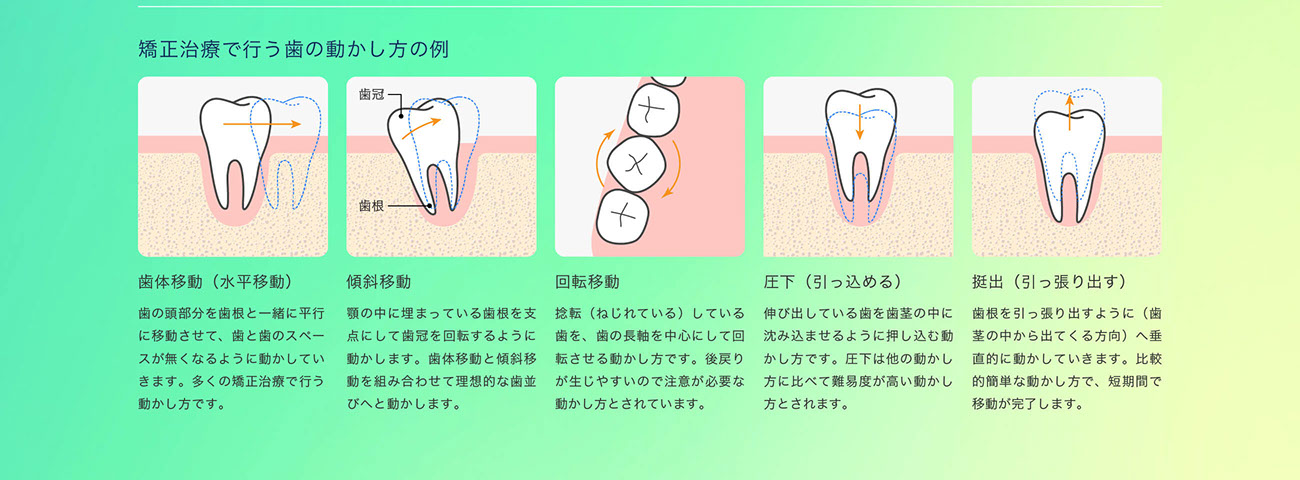 矯正治療で行う歯の動かし方の例