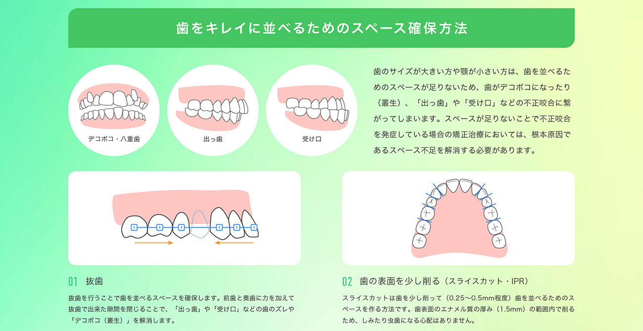 歯をキレイに並べるためのスペース確保方法