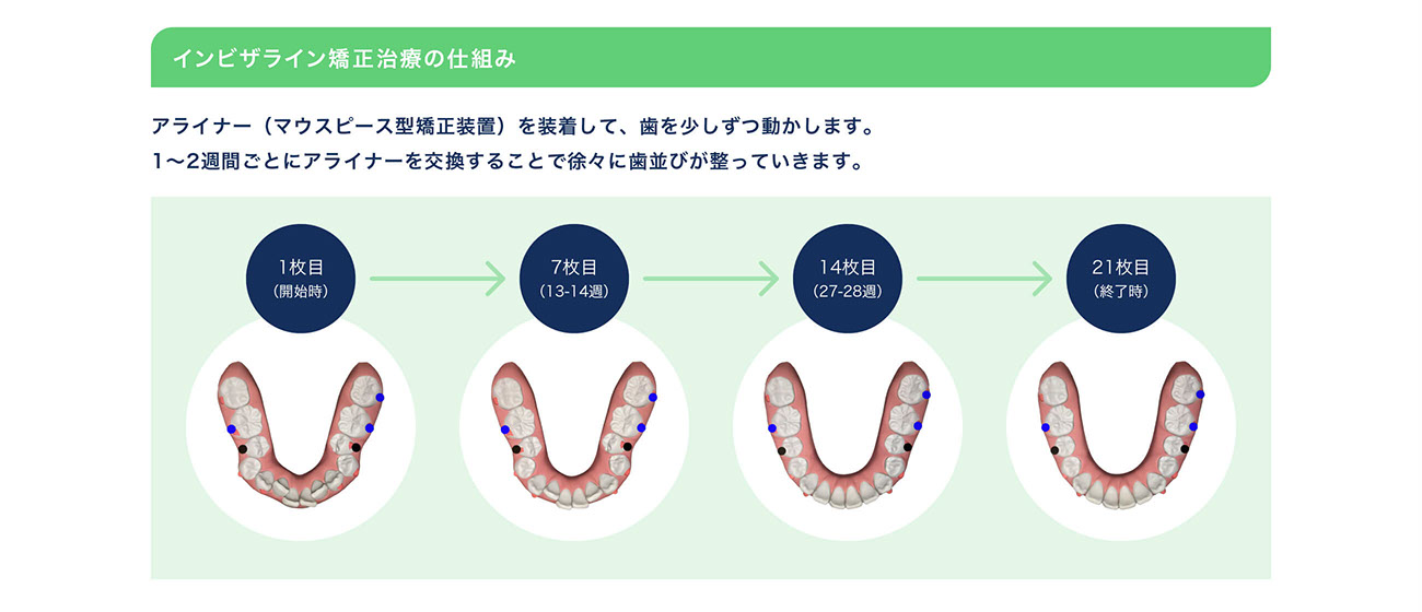 インビザライン矯正治療の仕組み