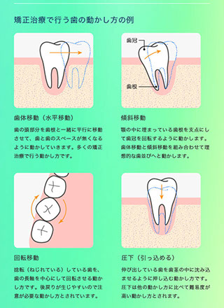 矯正治療で行う歯の動かし方の例