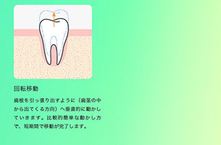 矯正治療で行う歯の動かし方の例