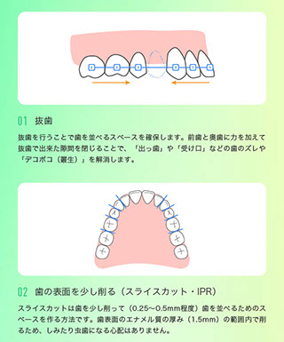 歯をキレイに並べるためのスペース確保方法