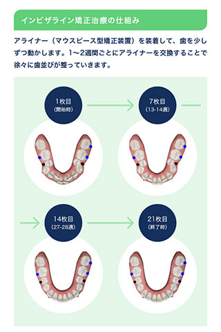 インビザライン矯正治療の仕組み